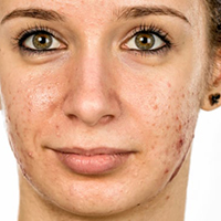 Have I got adult-onset acne – and do I need treatment?